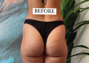 bbl Dubai | brazilian butt lift before and after |butt augmentation Al Wasl , Dubai