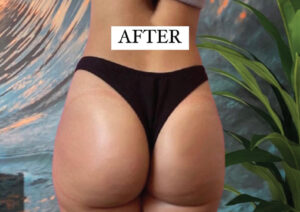 brazilian butt lift dubai |buttock augmentation in Dubai